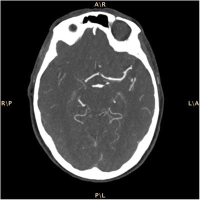 Cryptogenic ischemic stroke in cardiac transthyretin amyloidosis and sinus rhythm: a case report